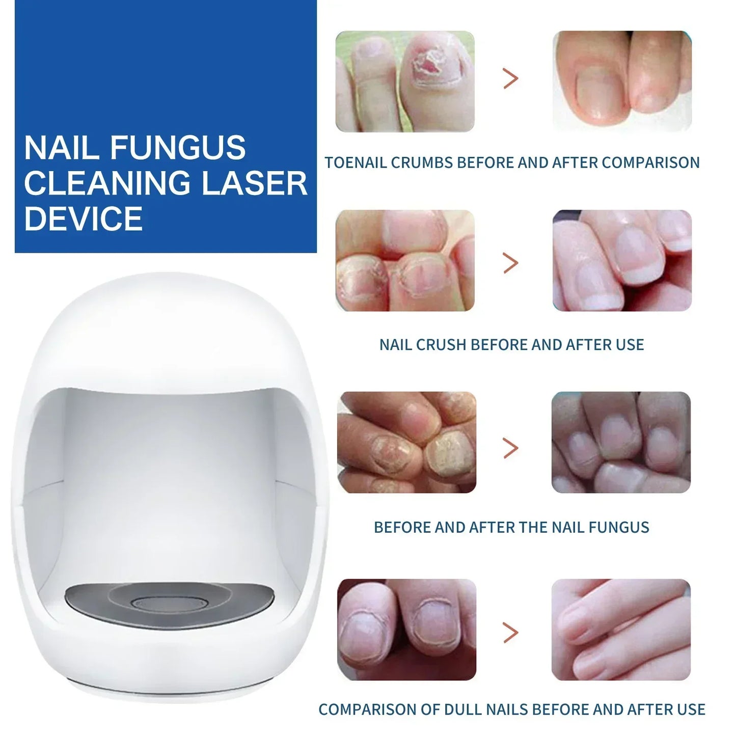 FungiGone Pro – Élimination des mycoses des ongles au laser 