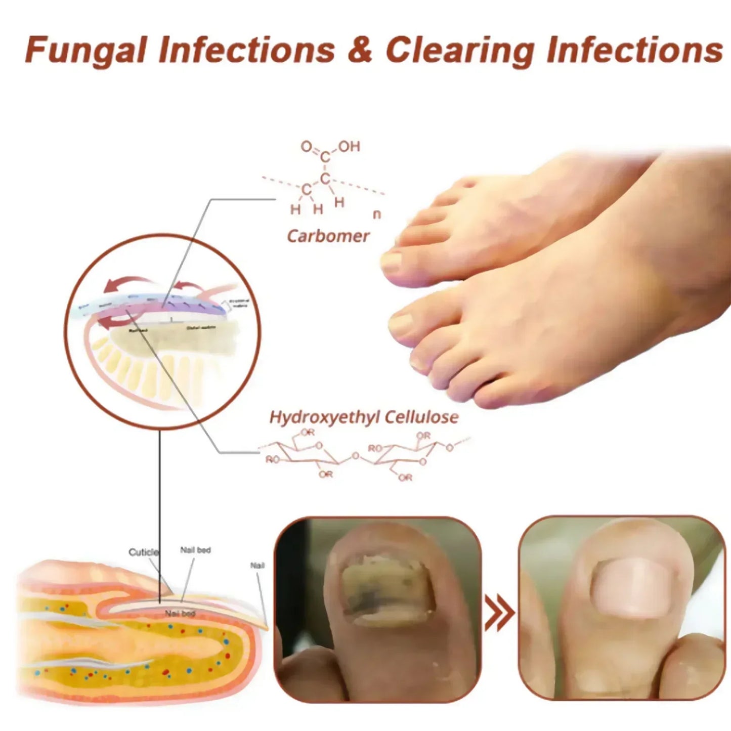 FungiGone Pro – Élimination des mycoses des ongles au laser 