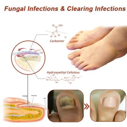 FungiGone Pro – Élimination des mycoses des ongles au laser 